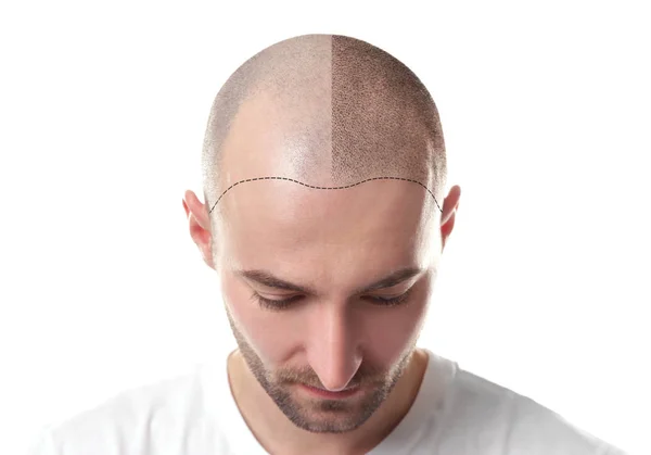 hair transplant
